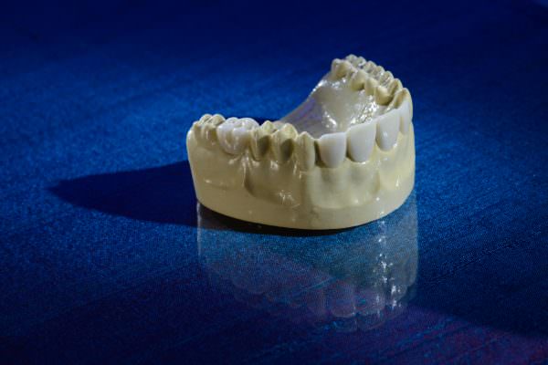 Diagnostic Wax-Ups are the blueprint to your final restorations