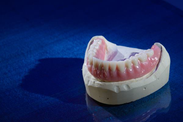 Denture Over Implant Bars and overdentures fabricated with the most advanced technology