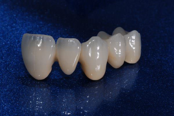 PFM – Porcelain Fused to Metal, Fabricating PFM, restorations from single units to full mouth rehabilitations